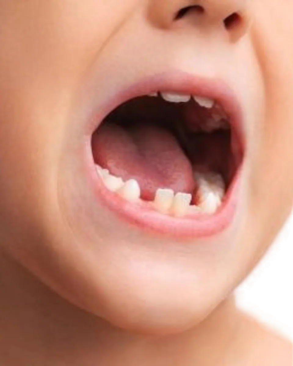 Orthodontie pédiatrique RCC pour enfants dès 3 ans par le Dr Patrice Bergeyron