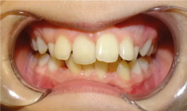 Avant traitement du chevauchement dentaire, dents mal alignées Genève