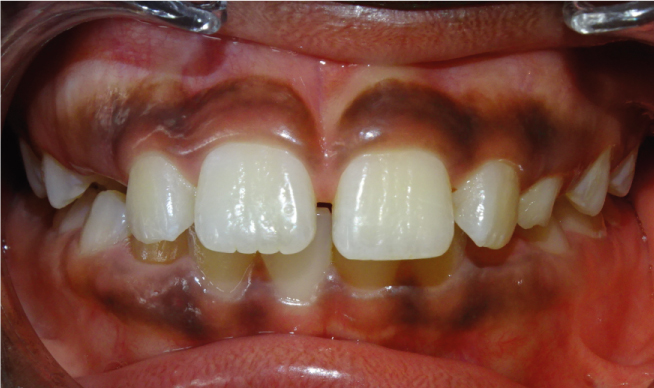 Avant traitement, espace entre les dents (diastème) à Genève
