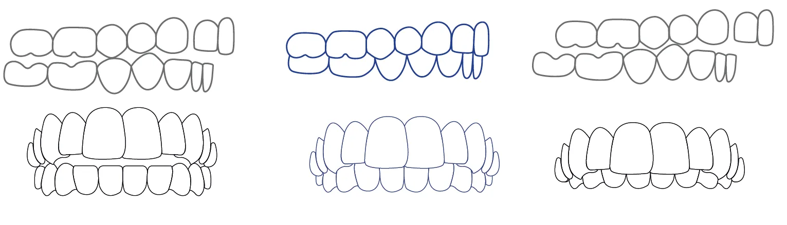 Solution 3 : orthodontie fonctionnelle pour adulte à Genève