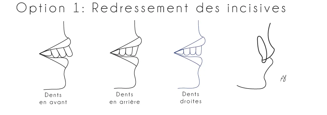 Solution 1 : orthodontie esthétique directe pour adulte à Genève