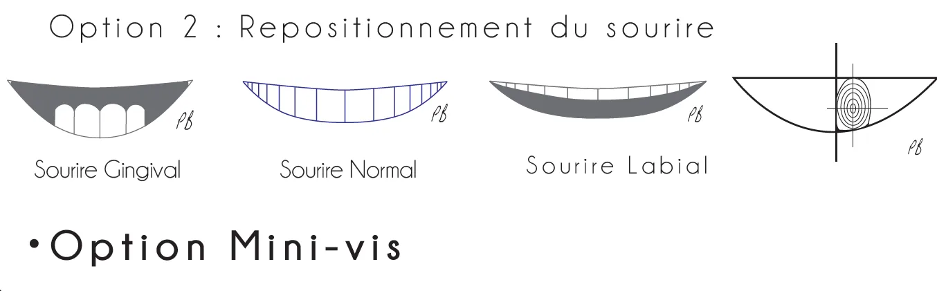 Solution 2 : alignement complet du sourire pour adulte à Genève