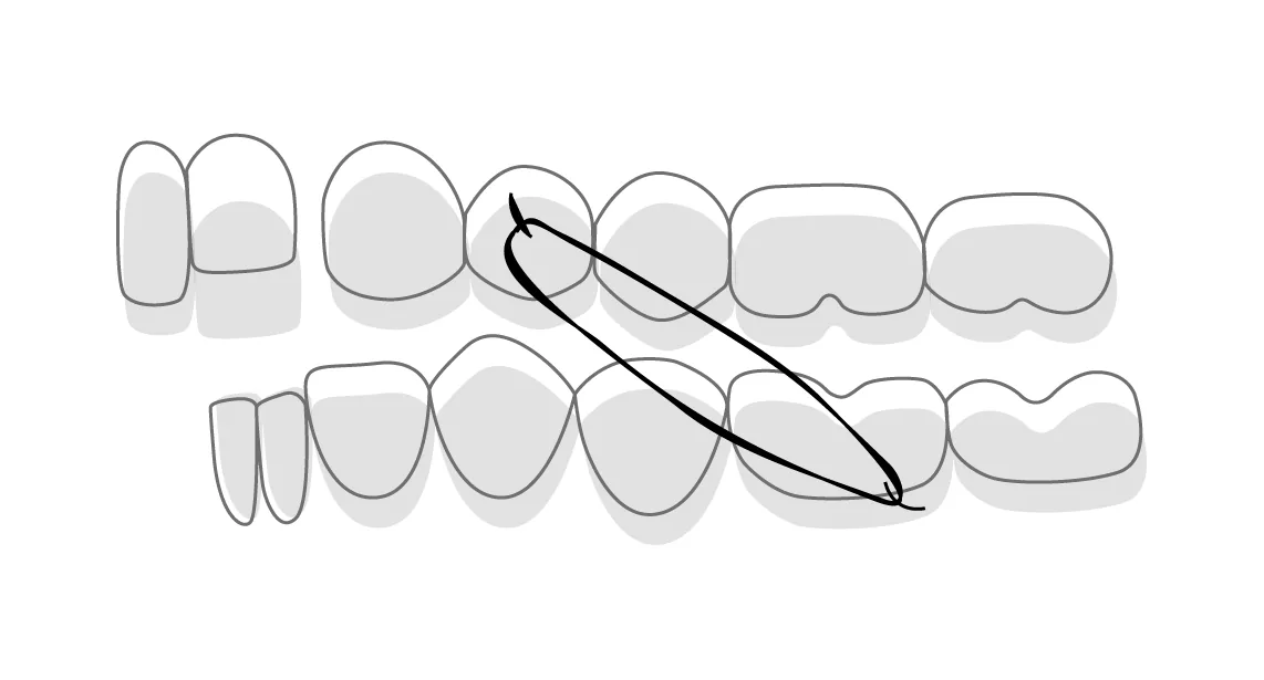 Élastiques orthodontiques pour améliorer l'occlusion chez l'adulte