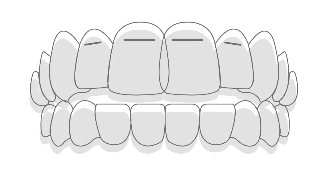Power Ridges, accessoire orthodontique pour aligneurs transparents