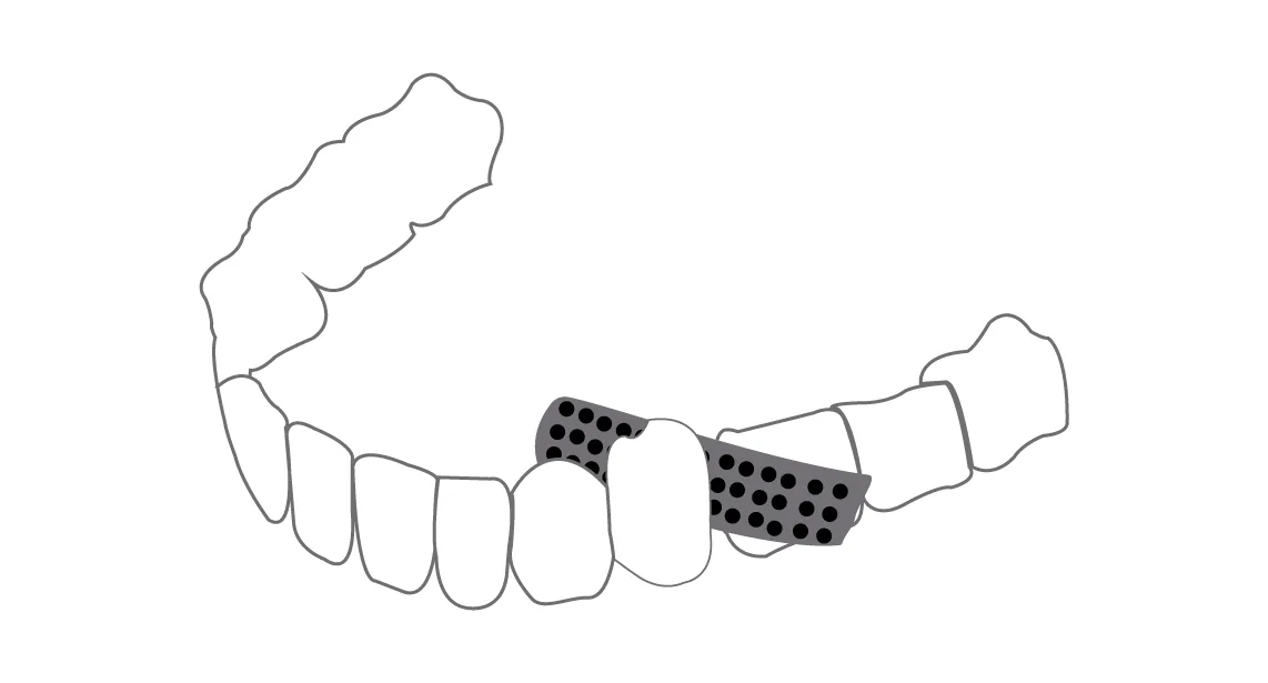 Stripping dentaire, technique d'orthodontie adulte pour alignement des dents
