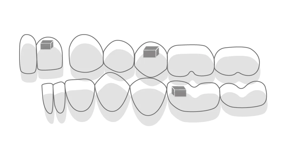 Taquets orthodontiques transparents pour aligneurs adultes