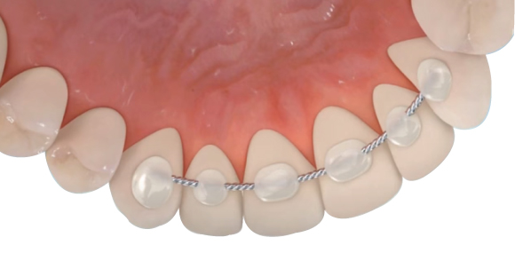 Le « syndrome du fil » de contention collé en orthodontie – L